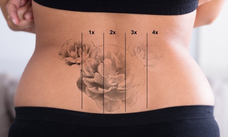 Laser-Tattoo-Removal-Duluth , ania beauty salon kilcoole , Ireland